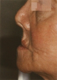 Facial Collapse - female