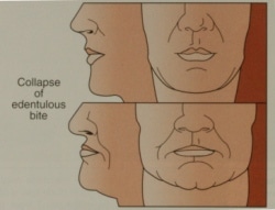 Facial Collapse diagram