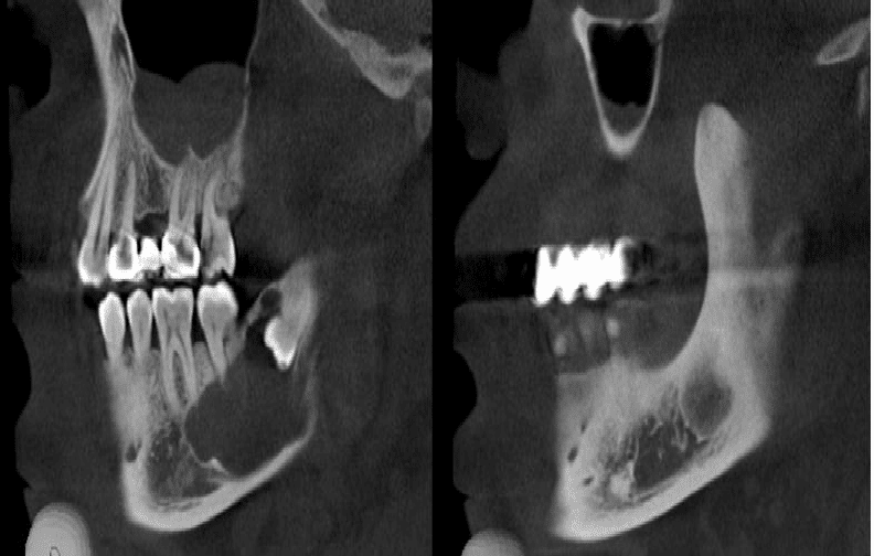 https://www.bestdentistguide.com/wp-content/uploads/2018/12/Sagittal-views-of-the-both-sides-of-mandible-show-two-mental-foramens-and-three-accessory.png