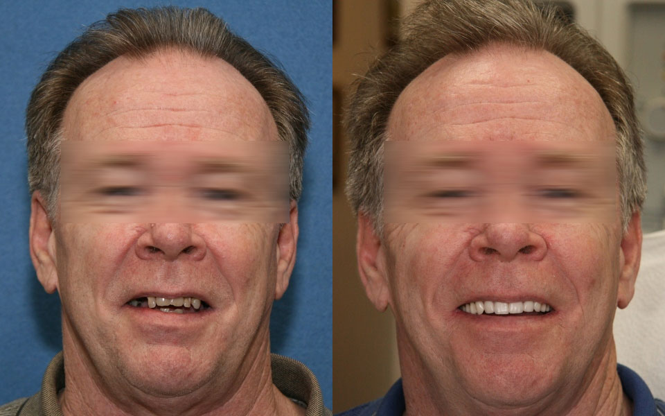 before and after dental implant surgery