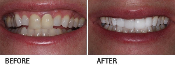 porcelain veneers