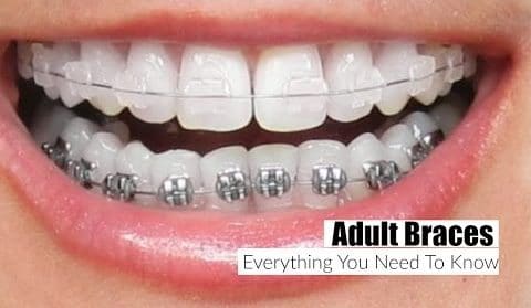 https://www.bestdentistguide.com/wp-content/uploads/2019/01/damon-clear-braces-vs-invisalign-8211-which-is-right-for-you-jcxfls3ATR4-e1567020865101.jpg