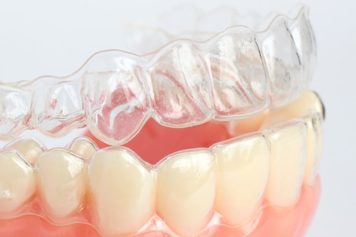 clear retainers 1 Everything You Need To Know About Clear Retainers.