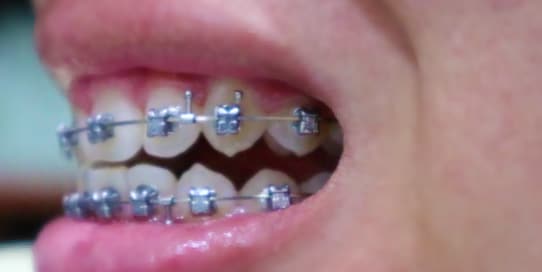 Are Damon  braces really better than regular braces Top 