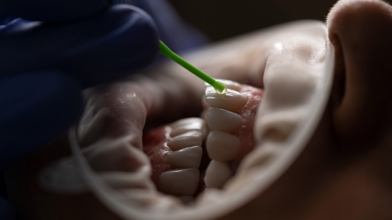 Why Dental Crowns Fall Off