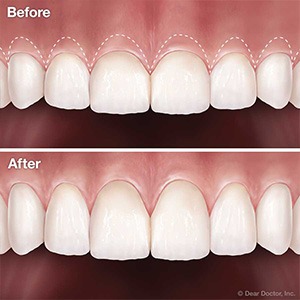 crown lengthening before and after