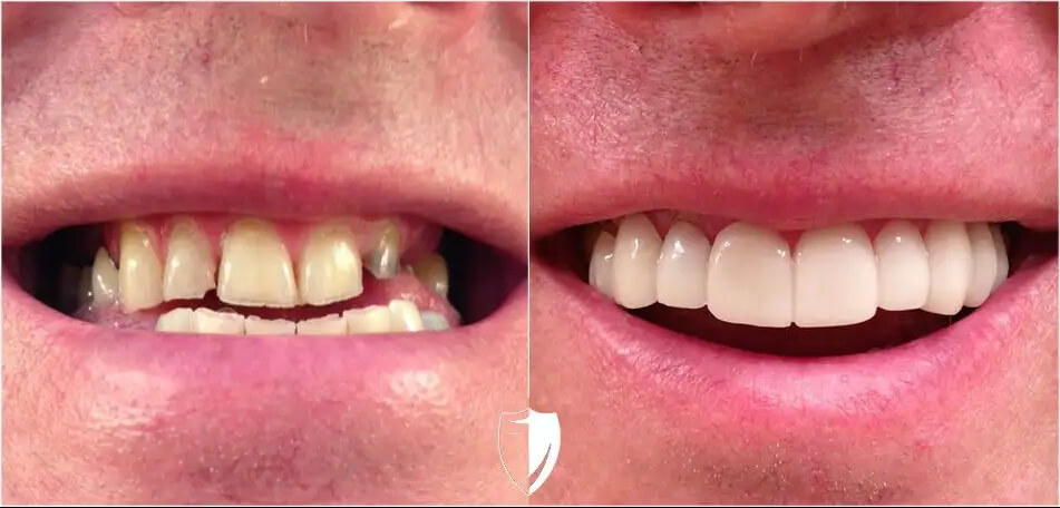 BilVeneers 