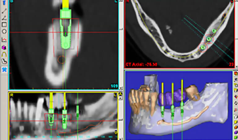 Computer Guided Implant Placement screenshot