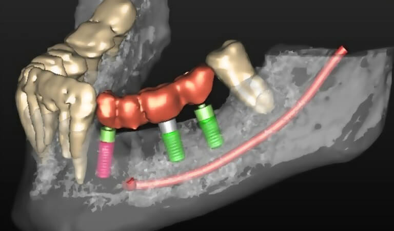 Computer Guided Implant Surgery