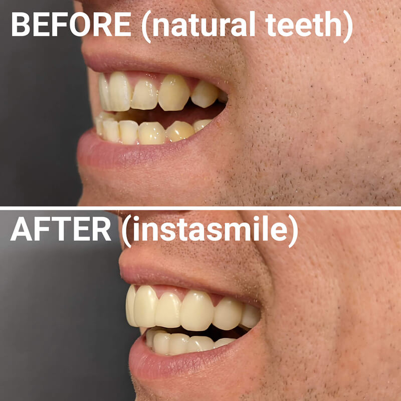 InstaSmile veneers