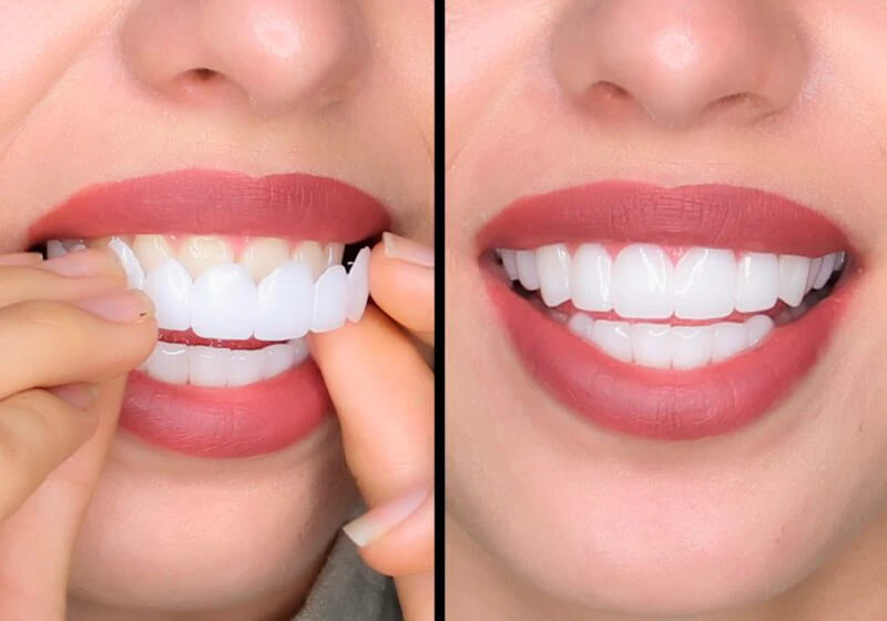 Secret Veneers