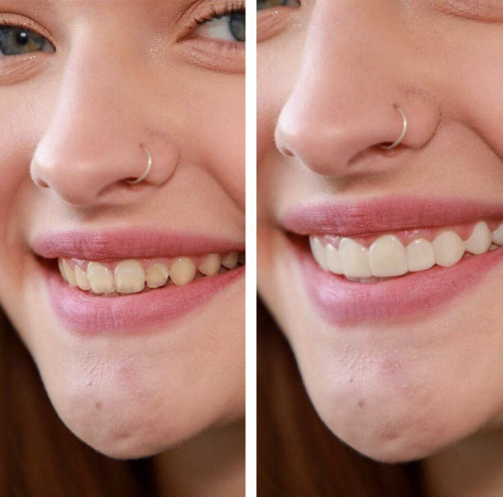 Shiny Smile Veneers