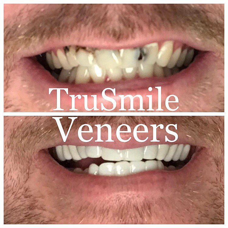 TruSmile Veneers before and after