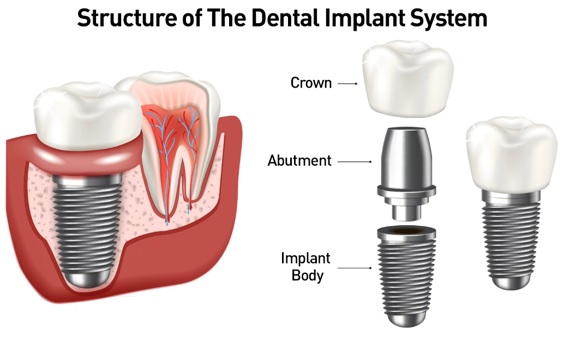 Dental Implants: What You Should Know | FDA