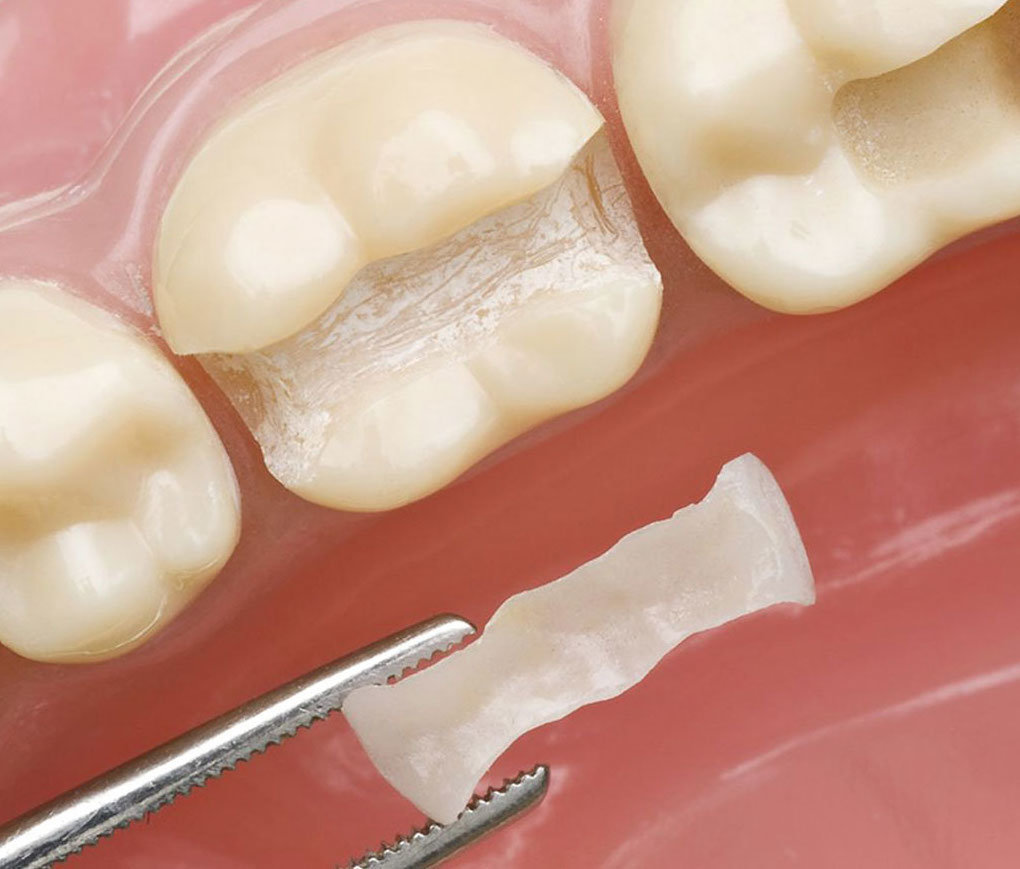 Indirect Restorations