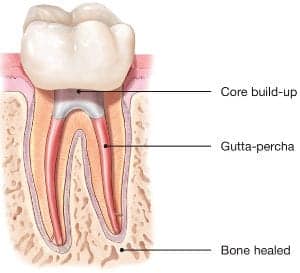 root canal save tooth