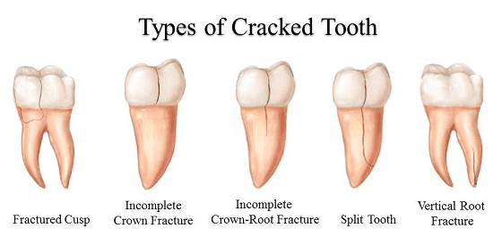 types of cracked teeth